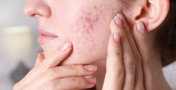 How to Heal and Prevent Acne the Right Way